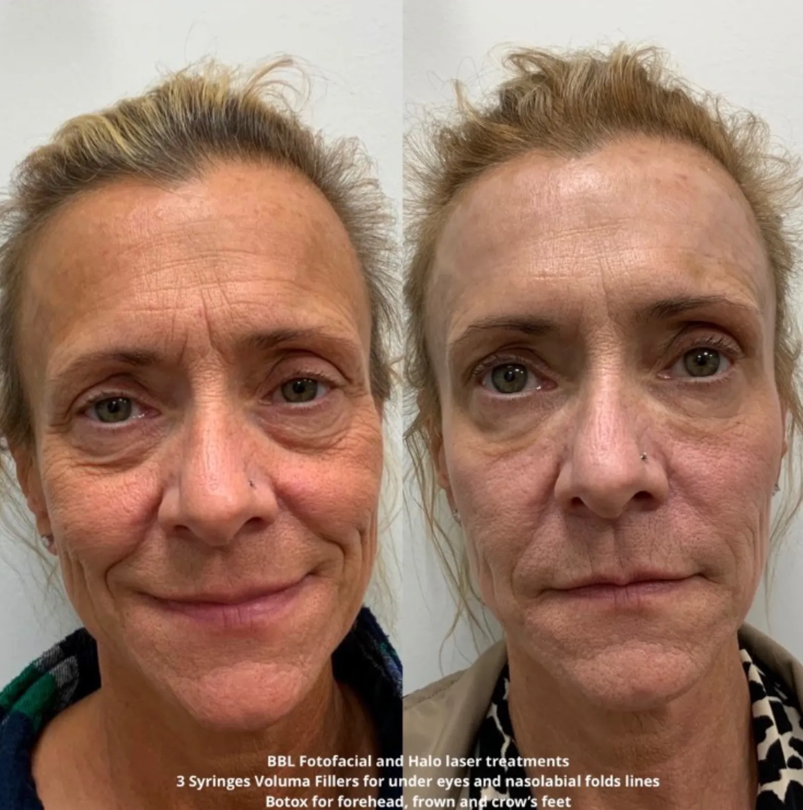 BBL before and after 4