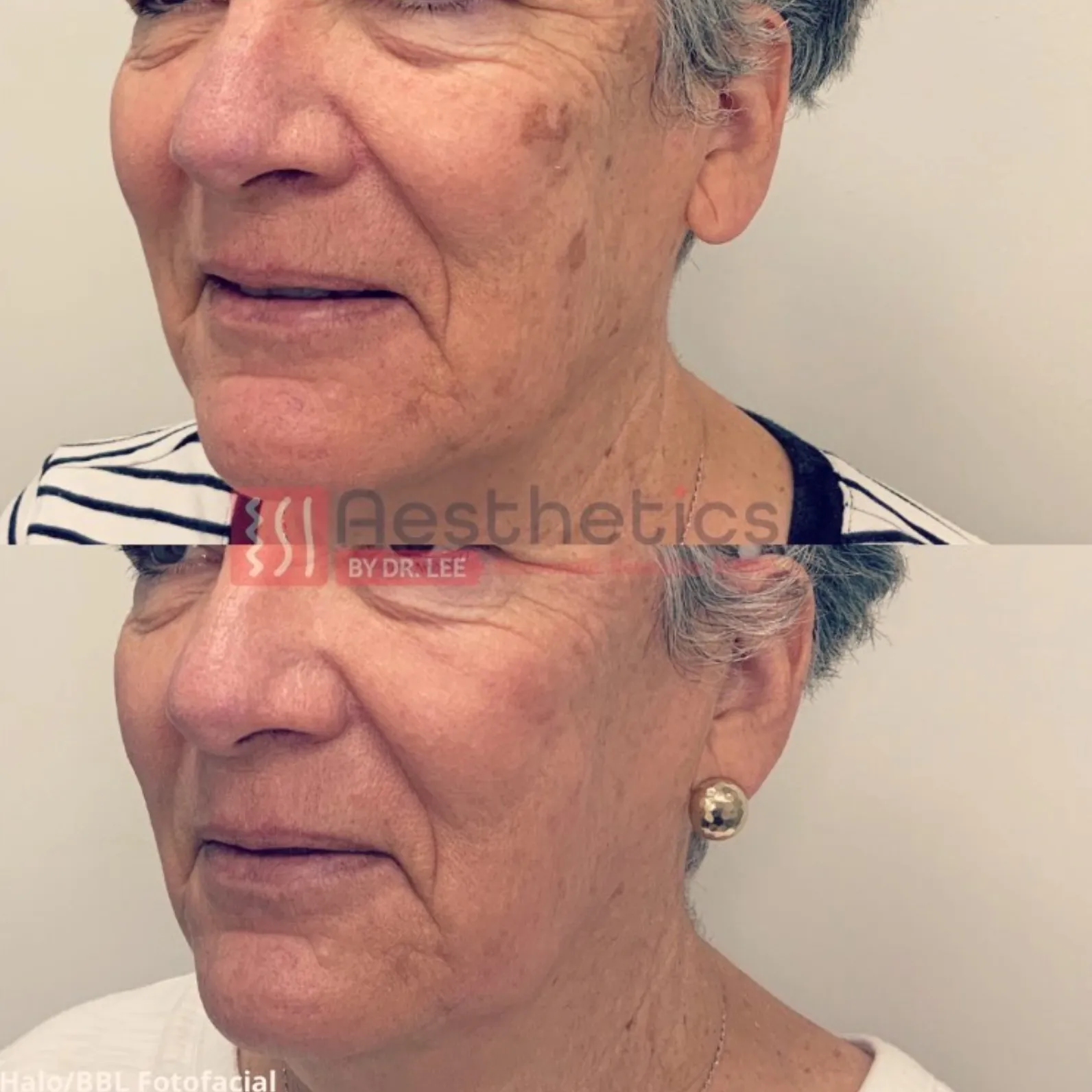 BBL before and after 2