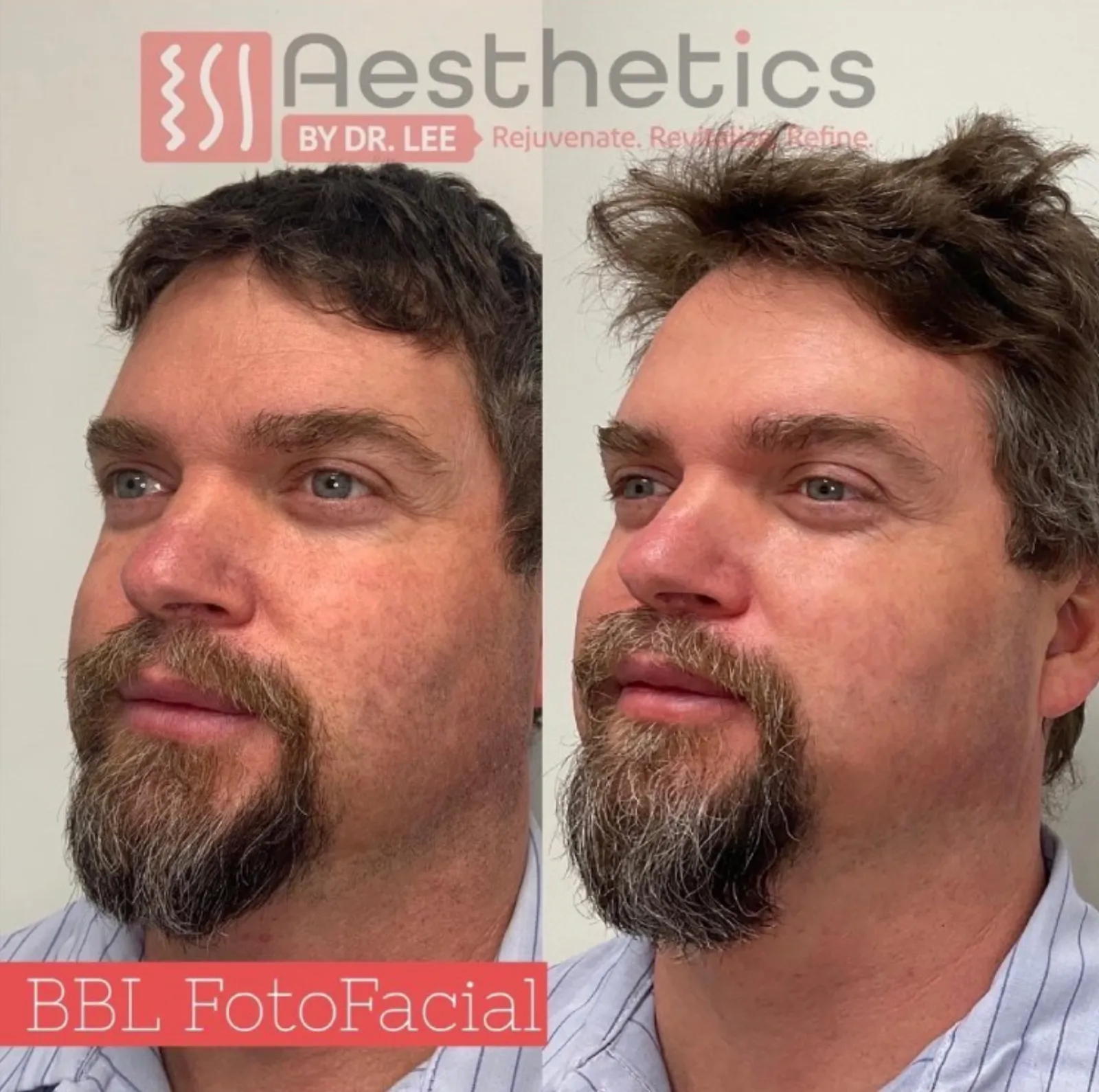 BBL before and after 1