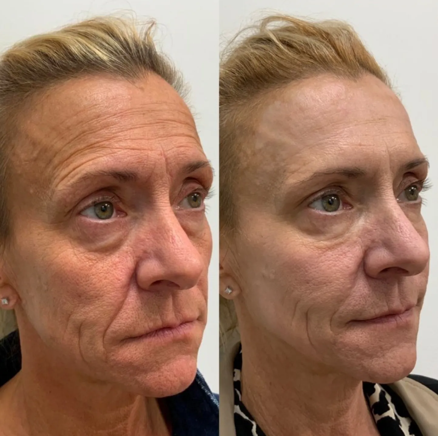 BBL before and after 3